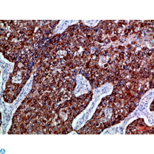 EPHB3 / EPH Receptor B3 Antibody - Immunohistochemical analysis of paraffin-embedded Human-lung-cancer, antibody was diluted at 1:100.