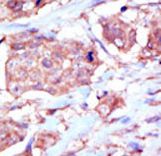 EPHB6 / EPH Receptor B6 Antibody - Formalin-fixed and paraffin-embedded human cancer tissue reacted with the primary antibody, which was peroxidase-conjugated to the secondary antibody, followed by DAB staining. This data demonstrates the use of this antibody for immunohistochemistry; clinical relevance has not been evaluated. BC = breast carcinoma; HC = hepatocarcinoma.