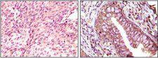 EPHB6 / EPH Receptor B6 Antibody - IHC of paraffin- embedded human bladder carcinoma (left) and return carcinoma (right) tissue, showing cytoplasmic localization using EphB6 mouse mAb with DAB staining.