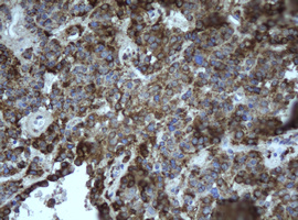 EPHX1 / Epoxide Hydrolase 1 Antibody - IHC of paraffin-embedded Carcinoma of Human pancreas tissue using anti-EPHX1 mouse monoclonal antibody. (Heat-induced epitope retrieval by 10mM citric buffer, pH6.0, 100C for 10min).