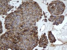 EPHX1 / Epoxide Hydrolase 1 Antibody - IHC of paraffin-embedded Carcinoma of Human pancreas tissue using anti-EPHX1 mouse monoclonal antibody. (Heat-induced epitope retrieval by 10mM citric buffer, pH6.0, 100C for 10min).