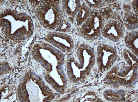 EPHX1 / Epoxide Hydrolase 1 Antibody - IHC of paraffin-embedded Carcinoma of Human prostate tissue using anti-EPHX1 mouse monoclonal antibody. (Heat-induced epitope retrieval by 10mM citric buffer, pH6.0, 100C for 10min).