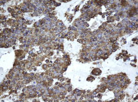 EPHX1 / Epoxide Hydrolase 1 Antibody - IHC of paraffin-embedded Carcinoma of Human pancreas tissue using anti-EPHX1 mouse monoclonal antibody.