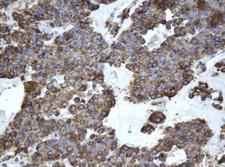 EPHX1 / Epoxide Hydrolase 1 Antibody - IHC of paraffin-embedded Carcinoma of Human pancreas tissue using anti-EPHX1 mouse monoclonal antibody.