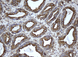 EPHX1 / Epoxide Hydrolase 1 Antibody - IHC of paraffin-embedded Carcinoma of Human prostate tissue using anti-EPHX1 mouse monoclonal antibody.