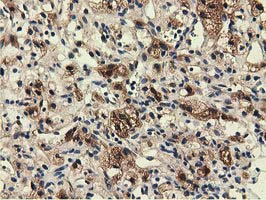 EPHX2 / Epoxide Hydrolase 2 Antibody - IHC of paraffin-embedded Carcinoma of Human kidney tissue using anti-EPHX2 mouse monoclonal antibody.
