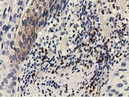 EPHX2 / Epoxide Hydrolase 2 Antibody - IHC of paraffin-embedded Carcinoma of Human bladder tissue using anti-EPHX2 mouse monoclonal antibody.