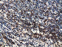 EPHX2 / Epoxide Hydrolase 2 Antibody - IHC of paraffin-embedded Human lymphoma tissue using anti-EPHX2 mouse monoclonal antibody.