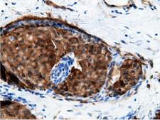 EPHX2 / Epoxide Hydrolase 2 Antibody - Immunohistochemical staining of paraffin-embedded Adenocarcinoma of Human breast tissue using anti-EPHX2 mouse monoclonal antibody.