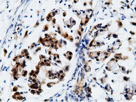 EPHX2 / Epoxide Hydrolase 2 Antibody - Immunohistochemical staining of paraffin-embedded Adenocarcinoma of Human colon tissue using anti-EPHX2 mouse monoclonal antibody.