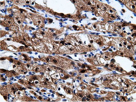 EPHX2 / Epoxide Hydrolase 2 Antibody - Immunohistochemical staining of paraffin-embedded Carcinoma of Human kidney tissue using anti-EPHX2 mouse monoclonal antibody.