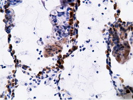 EPHX2 / Epoxide Hydrolase 2 Antibody - Immunohistochemical staining of paraffin-embedded Carcinoma of Human lung tissue using anti-EPHX2 mouse monoclonal antibody.