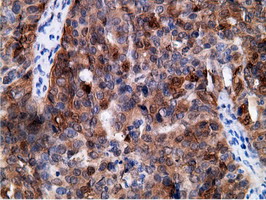 EPHX2 / Epoxide Hydrolase 2 Antibody - Immunohistochemical staining of paraffin-embedded Adenocarcinoma of Human ovary tissue using anti-EPHX2 mouse monoclonal antibody.