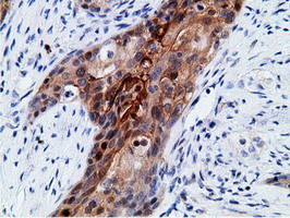 EPHX2 / Epoxide Hydrolase 2 Antibody - Immunohistochemical staining of paraffin-embedded Carcinoma of Human pancreas tissue using anti-EPHX2 mouse monoclonal antibody.