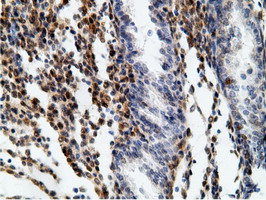EPHX2 / Epoxide Hydrolase 2 Antibody - Immunohistochemical staining of paraffin-embedded Carcinoma of Human bladder tissue using anti-EPHX2 mouse monoclonal antibody.