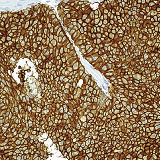 Epithelium Antibody - Formalin-fixed, paraffin-embedded human breast cancer stained with Epithelial Antigen antibody.