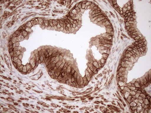 EPLIN Antibody - Immunohistochemical staining of paraffin-embedded Carcinoma of Human prostate tissue using anti-LIMA1 mouse monoclonal antibody. (Heat-induced epitope retrieval by 1mM EDTA in 10mM Tris buffer. (pH8.5) at 120°C for 3 min. (1:150)