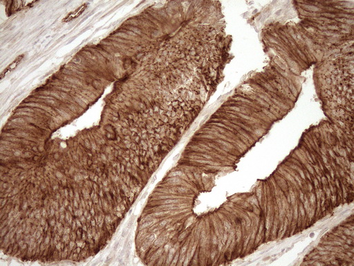 EPLIN Antibody - Immunohistochemical staining of paraffin-embedded Adenocarcinoma of Human colon tissue using anti-LIMA1 mouse monoclonal antibody. (Heat-induced epitope retrieval by 1mM EDTA in 10mM Tris buffer. (pH8.5) at 120°C for 3 min. (1:150)