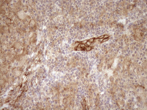 EPLIN Antibody - Immunohistochemical staining of paraffin-embedded Human lymph node tissue within the normal limits using anti-LIMA1 mouse monoclonal antibody. (Heat-induced epitope retrieval by 1mM EDTA in 10mM Tris buffer. (pH8.5) at 120°C for 3 min. (1:150)