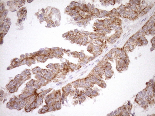 EPLIN Antibody - Immunohistochemical staining of paraffin-embedded Adenocarcinoma of Human ovary tissue using anti-LIMA1 mouse monoclonal antibody. (Heat-induced epitope retrieval by 1mM EDTA in 10mM Tris buffer. (pH8.5) at 120°C for 3 min. (1:150)