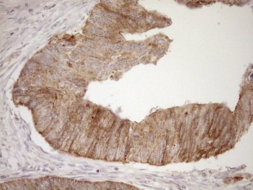 EPLIN Antibody - Immunohistochemical staining of paraffin-embedded Adenocarcinoma of Human colon tissue using anti-LIMA1 mouse monoclonal antibody. (Heat-induced epitope retrieval by 1mM EDTA in 10mM Tris buffer. (pH8.5) at 120°C for 3 min. (1:150)