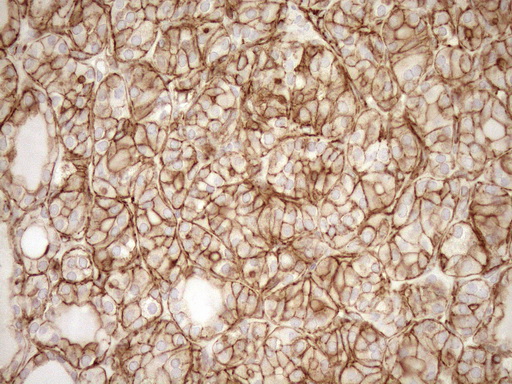 EPLIN Antibody - Immunohistochemical staining of paraffin-embedded Human thyroid tissue within the normal limits using anti-LIMA1 mouse monoclonal antibody. (Heat-induced epitope retrieval by 1mM EDTA in 10mM Tris buffer. (pH8.5) at 120°C for 3 min. (1:150)