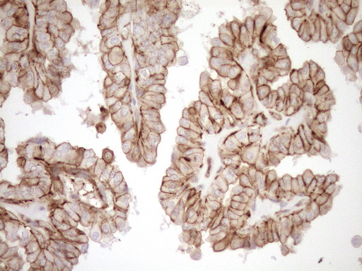 EPLIN Antibody - Immunohistochemical staining of paraffin-embedded Carcinoma of Human thyroid tissue using anti-LIMA1 mouse monoclonal antibody. (Heat-induced epitope retrieval by 1mM EDTA in 10mM Tris buffer. (pH8.5) at 120°C for 3 min. (1:150)