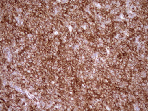 EPLIN Antibody - Immunohistochemical staining of paraffin-embedded Human lymphoma tissue using anti-LIMA1 mouse monoclonal antibody. (Heat-induced epitope retrieval by 1mM EDTA in 10mM Tris buffer. (pH8.5) at 120°C for 3 min. (1:150)