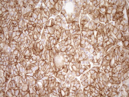 EPLIN Antibody - Immunohistochemical staining of paraffin-embedded Human thyroid tissue within the normal limits using anti-LIMA1 mouse monoclonal antibody. (Heat-induced epitope retrieval by 1mM EDTA in 10mM Tris buffer. (pH8.5) at 120°C for 3 min. (1:150)