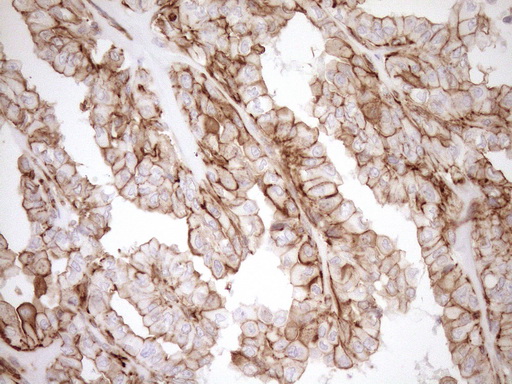EPLIN Antibody - Immunohistochemical staining of paraffin-embedded Carcinoma of Human thyroid tissue using anti-LIMA1 mouse monoclonal antibody. (Heat-induced epitope retrieval by 1mM EDTA in 10mM Tris buffer. (pH8.5) at 120°C for 3 min. (1:150)