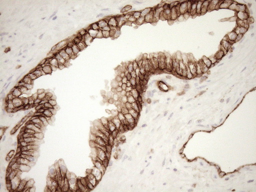 EPLIN Antibody - Immunohistochemical staining of paraffin-embedded Carcinoma of Human prostate tissue using anti-LIMA1 mouse monoclonal antibody. (Heat-induced epitope retrieval by 1mM EDTA in 10mM Tris buffer. (pH8.5) at 120°C for 3 min. (1:150)