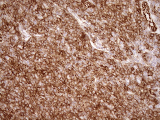 EPLIN Antibody - Immunohistochemical staining of paraffin-embedded Human lymphoma tissue using anti-LIMA1 mouse monoclonal antibody. (Heat-induced epitope retrieval by 1mM EDTA in 10mM Tris buffer. (pH8.5) at 120°C for 3 min. (1:150)