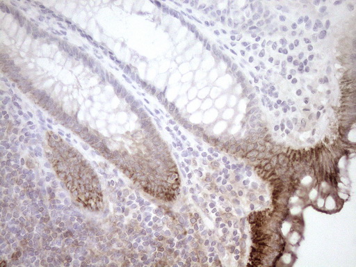 EPLIN Antibody - Immunohistochemical staining of paraffin-embedded Human colon tissue within the normal limits using anti-LIMA1 mouse monoclonal antibody. (Heat-induced epitope retrieval by 1mM EDTA in 10mM Tris buffer. (pH8.5) at 120°C for 3 min. (1:150)