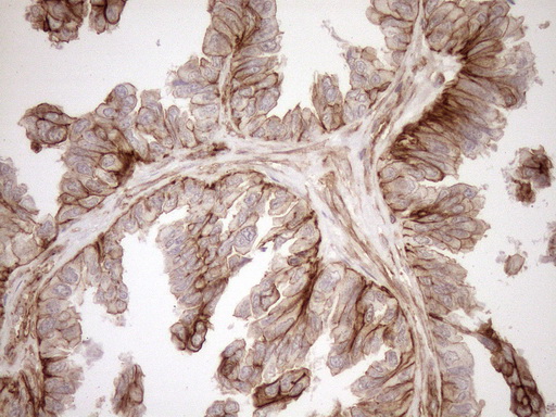 EPLIN Antibody - Immunohistochemical staining of paraffin-embedded Adenocarcinoma of Human ovary tissue using anti-LIMA1 mouse monoclonal antibody. (Heat-induced epitope retrieval by 1mM EDTA in 10mM Tris buffer. (pH8.5) at 120°C for 3 min. (1:150)