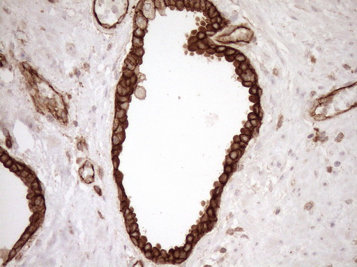 EPLIN Antibody - Immunohistochemical staining of paraffin-embedded Carcinoma of Human prostate tissue using anti-LIMA1 mouse monoclonal antibody. (Heat-induced epitope retrieval by 1mM EDTA in 10mM Tris buffer. (pH8.5) at 120°C for 3 min. (1:150)