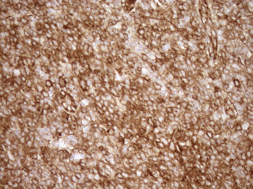 EPLIN Antibody - Immunohistochemical staining of paraffin-embedded Human lymphoma tissue using anti-LIMA1 mouse monoclonal antibody. (Heat-induced epitope retrieval by 1mM EDTA in 10mM Tris buffer. (pH8.5) at 120°C for 3 min. (1:150)