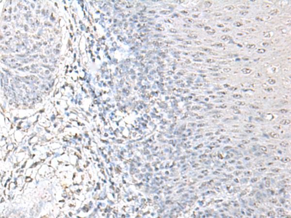 EPM2A / Laforin Antibody - Immunohistochemistry of paraffin-embedded Human esophagus cancer tissue  using EPM2A Polyclonal Antibody at dilution of 1:55(×200)