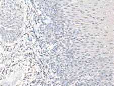 EPM2A / Laforin Antibody - Immunohistochemistry of paraffin-embedded Human esophagus cancer tissue  using EPM2A Polyclonal Antibody at dilution of 1:55(×200)