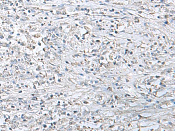 EPM2A / Laforin Antibody - Immunohistochemistry of paraffin-embedded Human liver cancer tissue  using EPM2A Polyclonal Antibody at dilution of 1:55(×200)