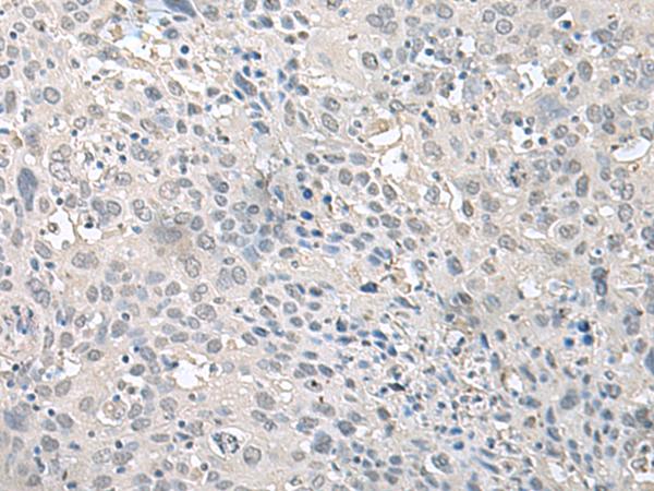 EPM2A / Laforin Antibody - Immunohistochemistry of paraffin-embedded Human cervical cancer tissue  using EPM2A Polyclonal Antibody at dilution of 1:75(×200)