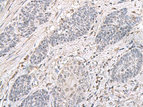 EPM2A / Laforin Antibody - Immunohistochemistry of paraffin-embedded Human esophagus cancer tissue  using EPM2A Polyclonal Antibody at dilution of 1:75(×200)