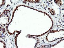EPM2AIP1 Antibody - IHC of paraffin-embedded Human breast tissue using anti-EPM2AIP1 mouse monoclonal antibody.