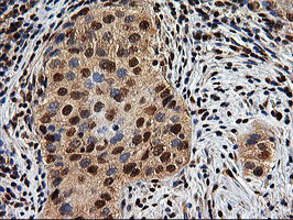 EPM2AIP1 Antibody - IHC of paraffin-embedded Carcinoma of Human bladder tissue using anti-EPM2AIP1 mouse monoclonal antibody.