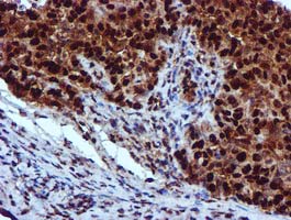 EPM2AIP1 Antibody - IHC of paraffin-embedded Adenocarcinoma of Human ovary tissue using anti-EPM2AIP1 mouse monoclonal antibody.