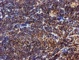 EPM2AIP1 Antibody - IHC of paraffin-embedded Human lymphoma tissue using anti-EPM2AIP1 mouse monoclonal antibody.