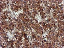 EPM2AIP1 Antibody - IHC of paraffin-embedded Carcinoma of Human liver tissue using anti-EPM2AIP1 mouse monoclonal antibody.
