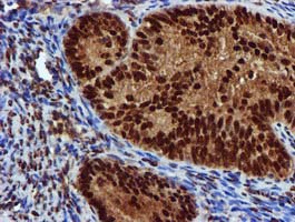 EPM2AIP1 Antibody - IHC of paraffin-embedded Adenocarcinoma of Human endometrium tissue using anti-EPM2AIP1 mouse monoclonal antibody.
