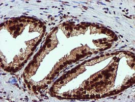 EPM2AIP1 Antibody - IHC of paraffin-embedded Carcinoma of Human prostate tissue using anti-EPM2AIP1 mouse monoclonal antibody.