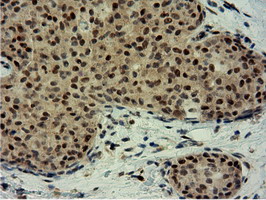 EPM2AIP1 Antibody - IHC of paraffin-embedded Adenocarcinoma of Human breast tissue using anti-EPM2AIP1 mouse monoclonal antibody.