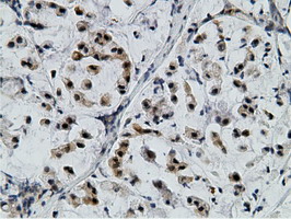 EPM2AIP1 Antibody - IHC of paraffin-embedded Adenocarcinoma of Human colon tissue using anti-EPM2AIP1 mouse monoclonal antibody.